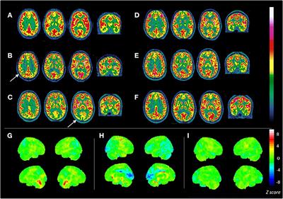 Relevance of Brain 18F-FDG PET Imaging in Probable Seronegative Encephalitis With Catatonia: A Case Report